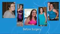 Successful Bariatric Surgery - Tijuana - Veronica's Testimonial