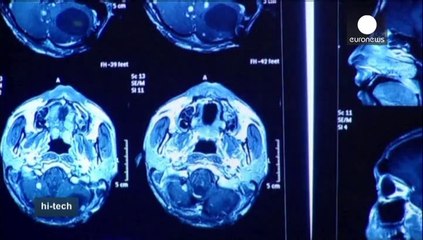 ECVT: Atividade cerebral elétrica