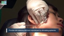 Facial Thread Lifting Korea