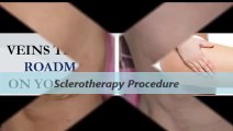 Kleinman Plastic Surgery Sclerotherapy Pocedure