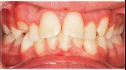 Johnson Orthodontist Dallas Sept2014