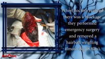 SHOCKING: 4KG Hairball found in Girl’s Stomach