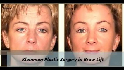 Kleinman Plastic Surgery Brow Lift Procedure