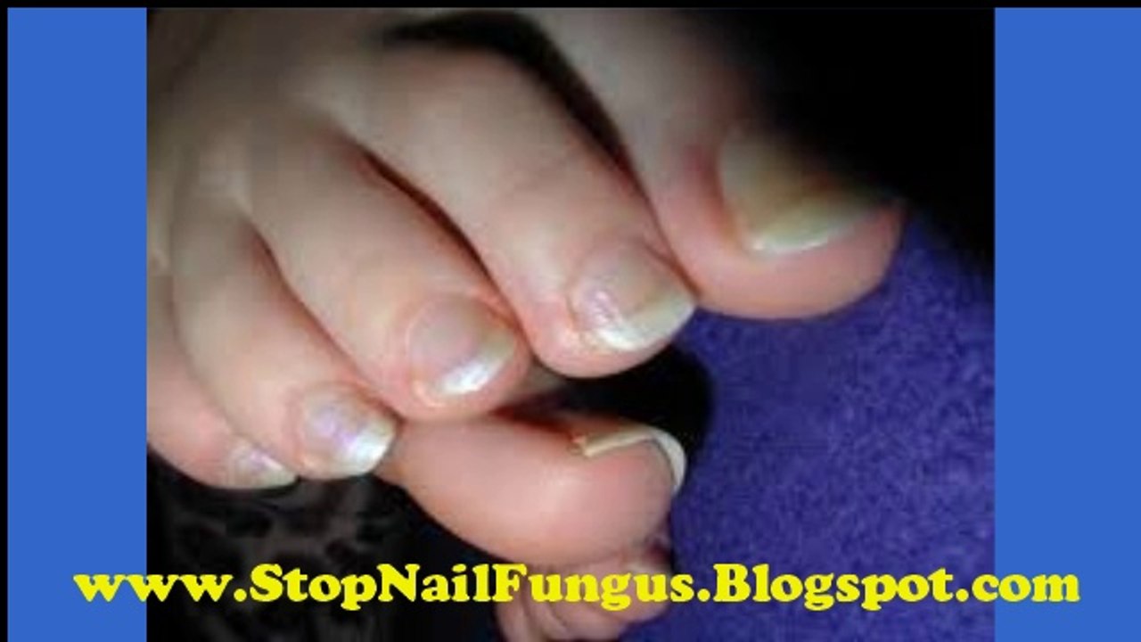 Nail Fungus Home Remedies - How To Cure Fungus Nails