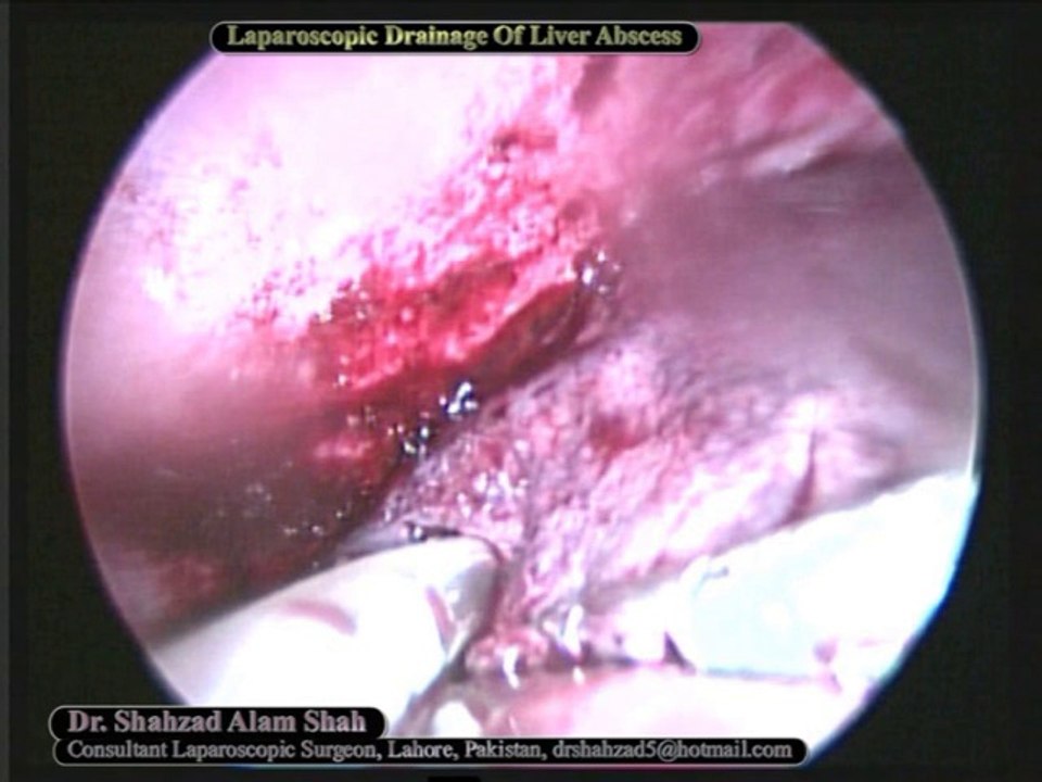 Laparoscopic Liver Abscess Drainage
