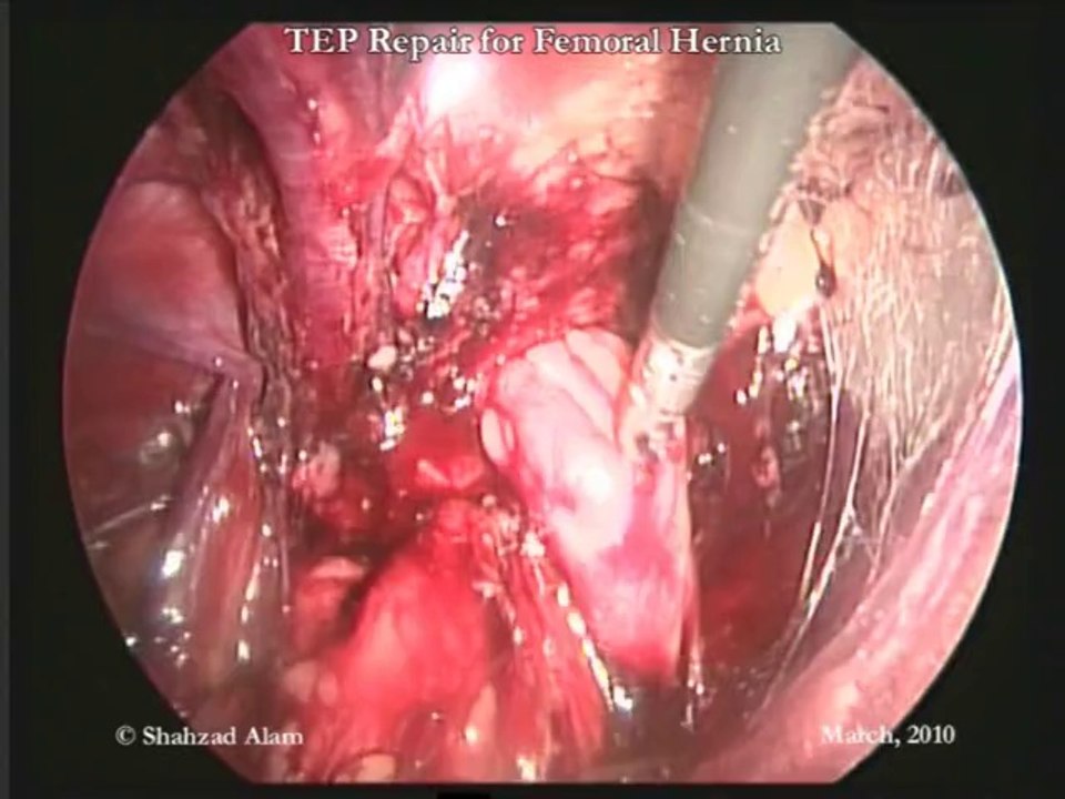 Femoral Hernia TEP Repair: Laparoscopic Repair