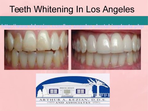 Get perfect smile with dental implants