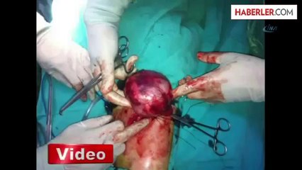 2 Yaşındaki Çocuğun Böbreğinden 300 Gram Kist Çıktı