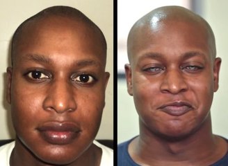 Man gets a permanent eye colour change