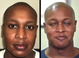 Man gets a permanent eye colour change