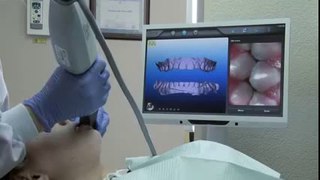 Glassman Dental Care iTero® Orthodontic Scan Demo