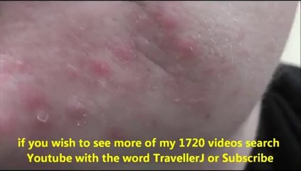 Acne Rosacea-40 seconds video of a case
