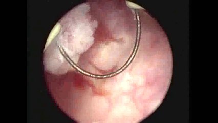 bladder tumour