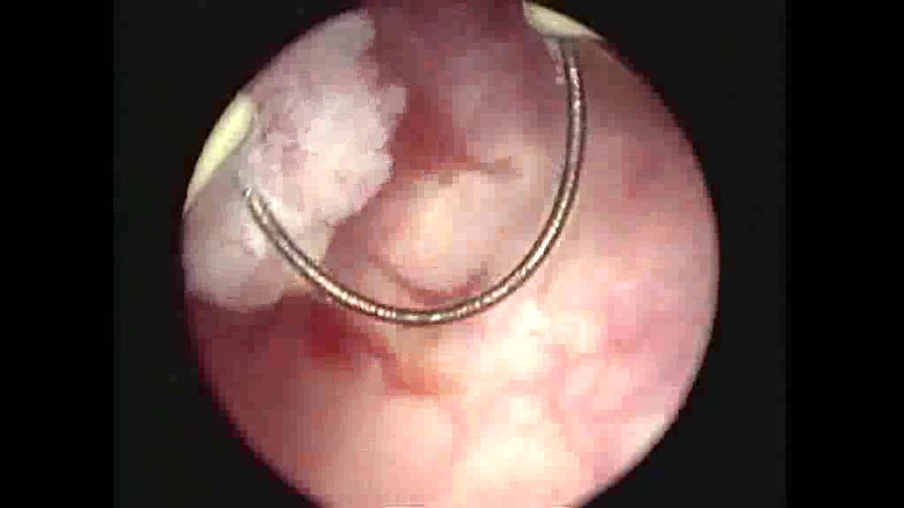 bladder tumour