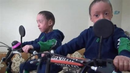 Balık Pulu Hastalığına Yakalanan İkizlerin Gözleri Açıldı