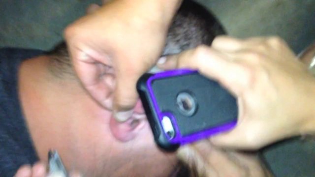 2 insectes coincés dans l'oreille d'un homme : une tique et un papillon de nuit!