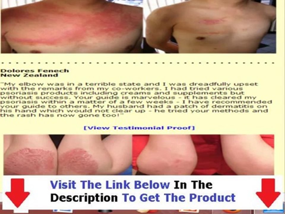 Psoriasis Free For Life Review + Discount Link Bonus + Discount