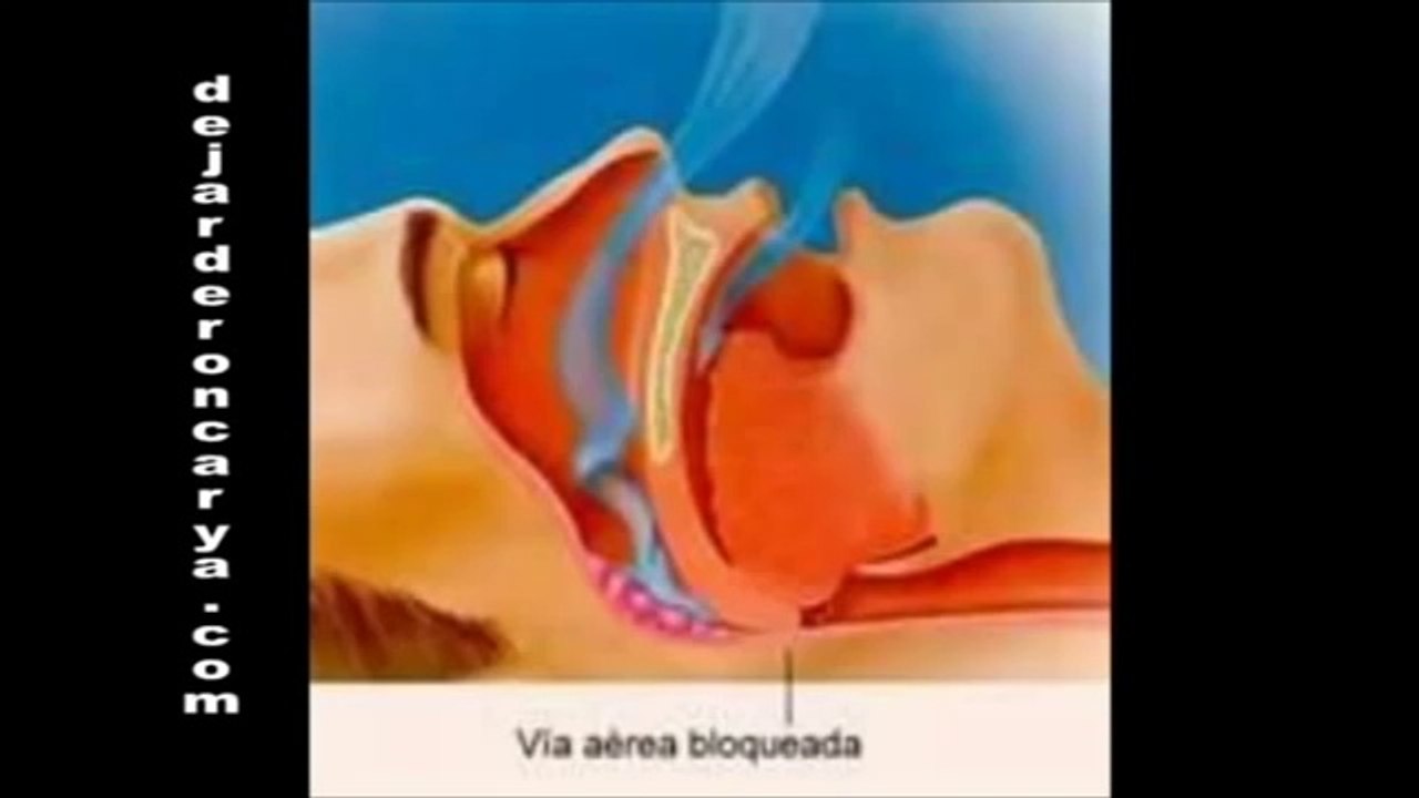 Roncar solución - Dejar de roncar hoy