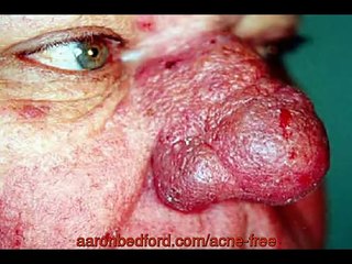 Be Acne Free in 3 Days Testimonial # 1