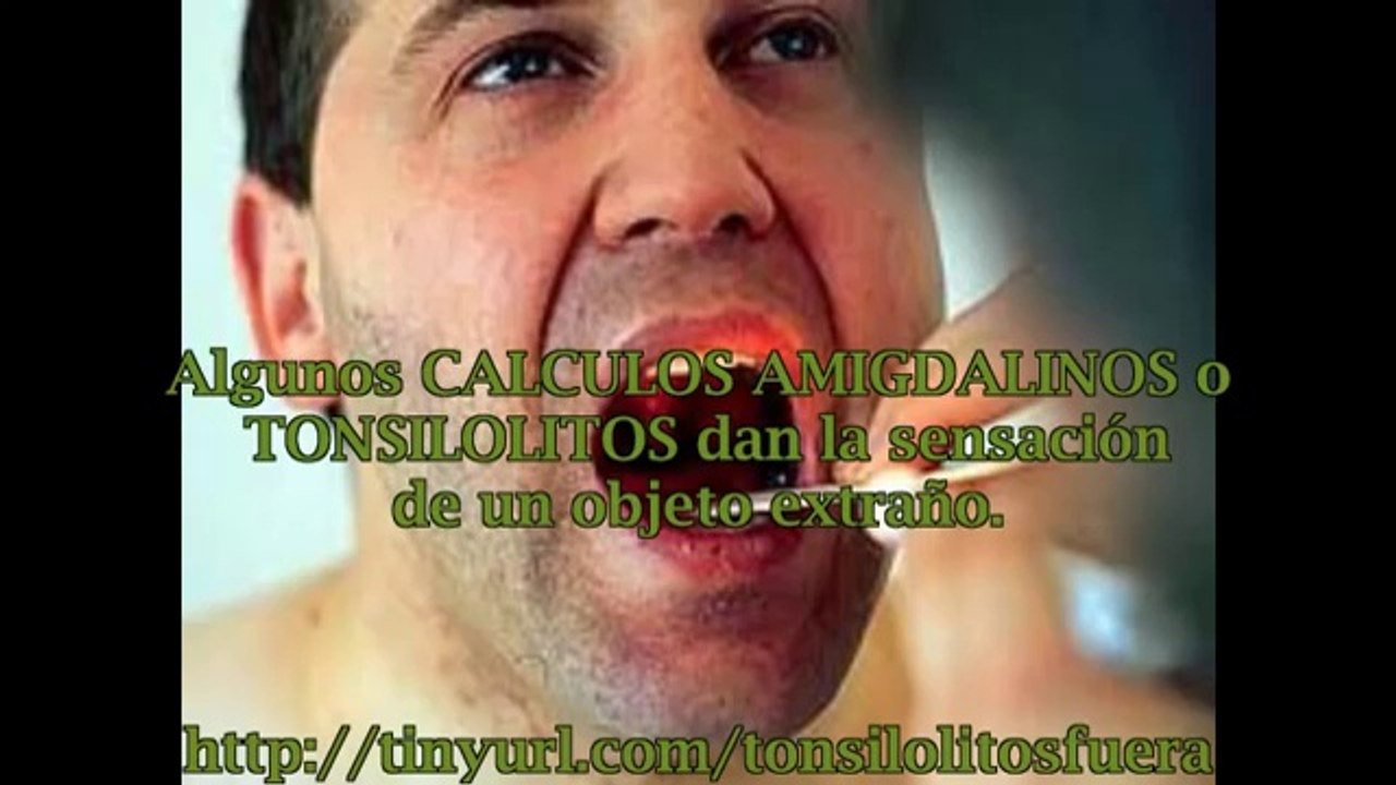Calculos amigdalinos tratamiento casero