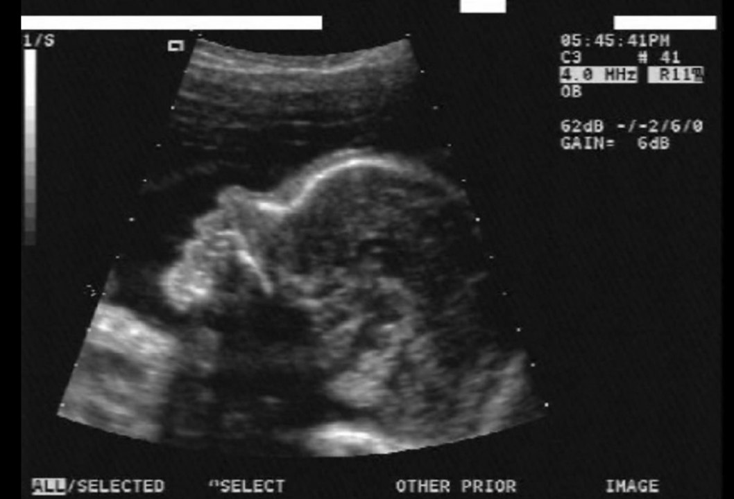 Feto morto uccide un bambino neonato | PIRATE TAPES