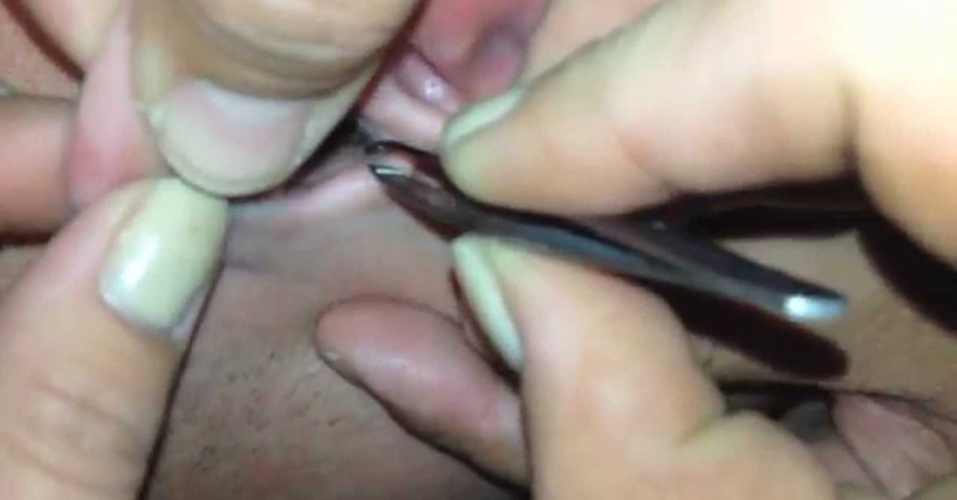 Crazy - Bug Buried In Guy’s Ear