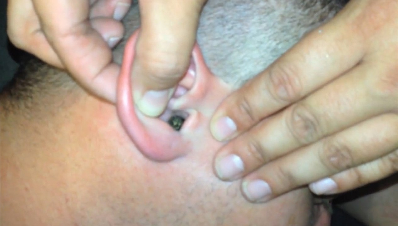 Huge Moth Burried In Big Guy's Ear