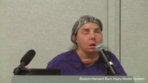 Woman Gets New Outlook On Life After Face Transplant