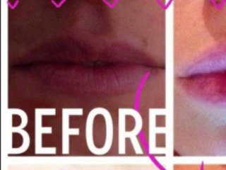 Dermal Filler Leeds - www.claesthetics.com