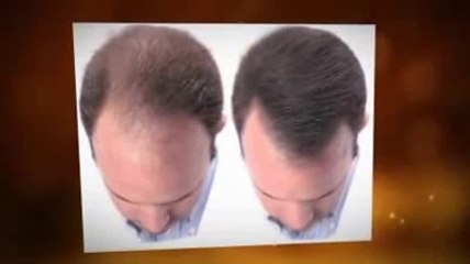 Hair Loss Blueprint Review By Derick