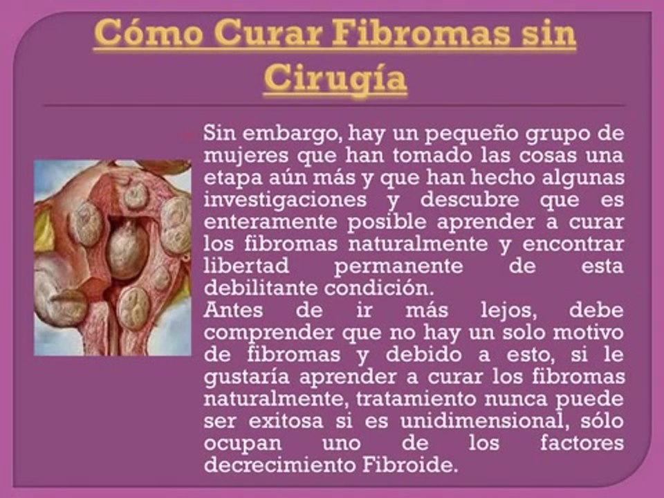 Cómo Curar Fibromas sin Cirugía