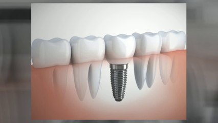 Dental Implants Manchester Dentist