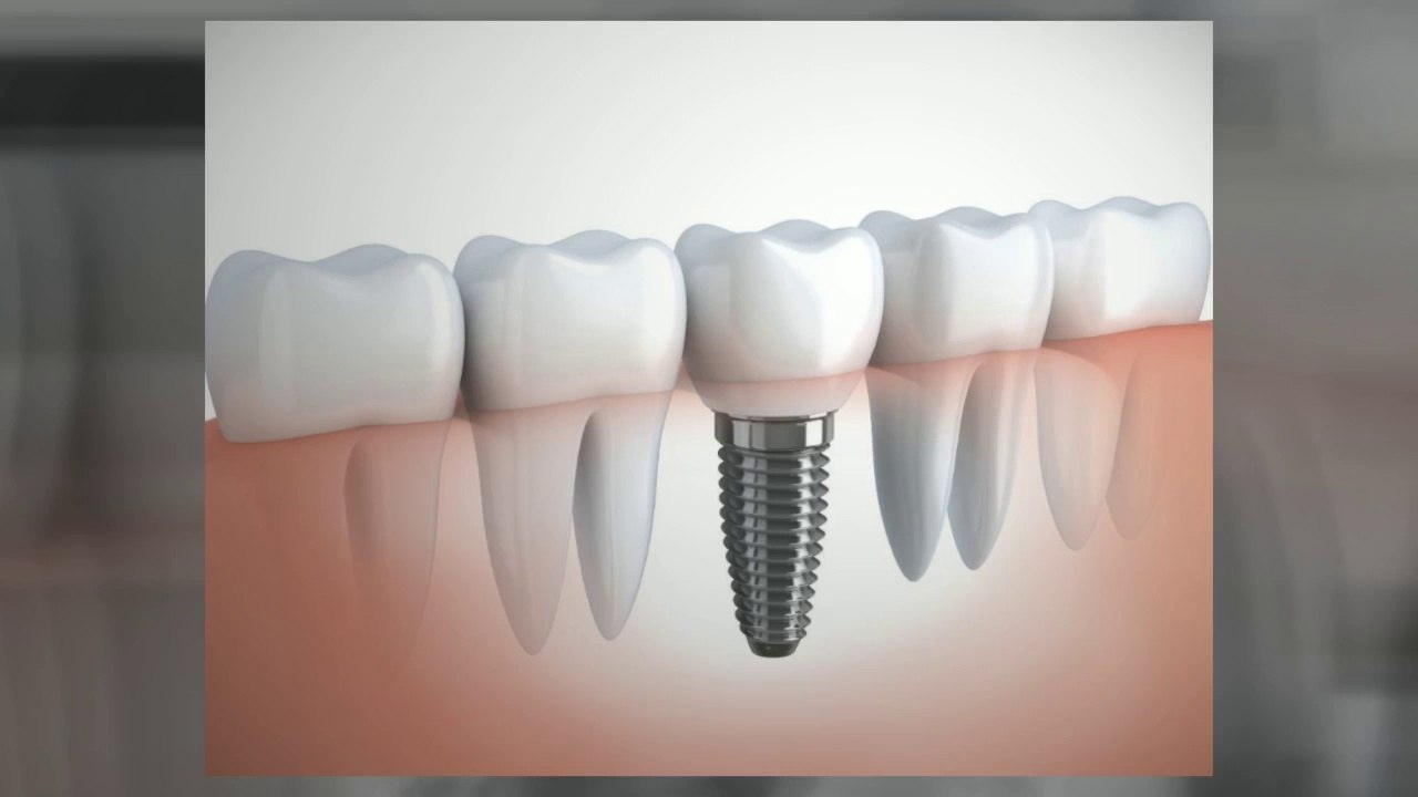 Dental Implants Manchester Dentist