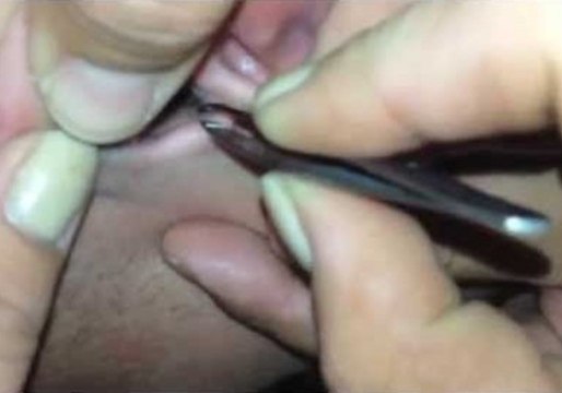Man Freaks Out at Bug Buried in His Ear