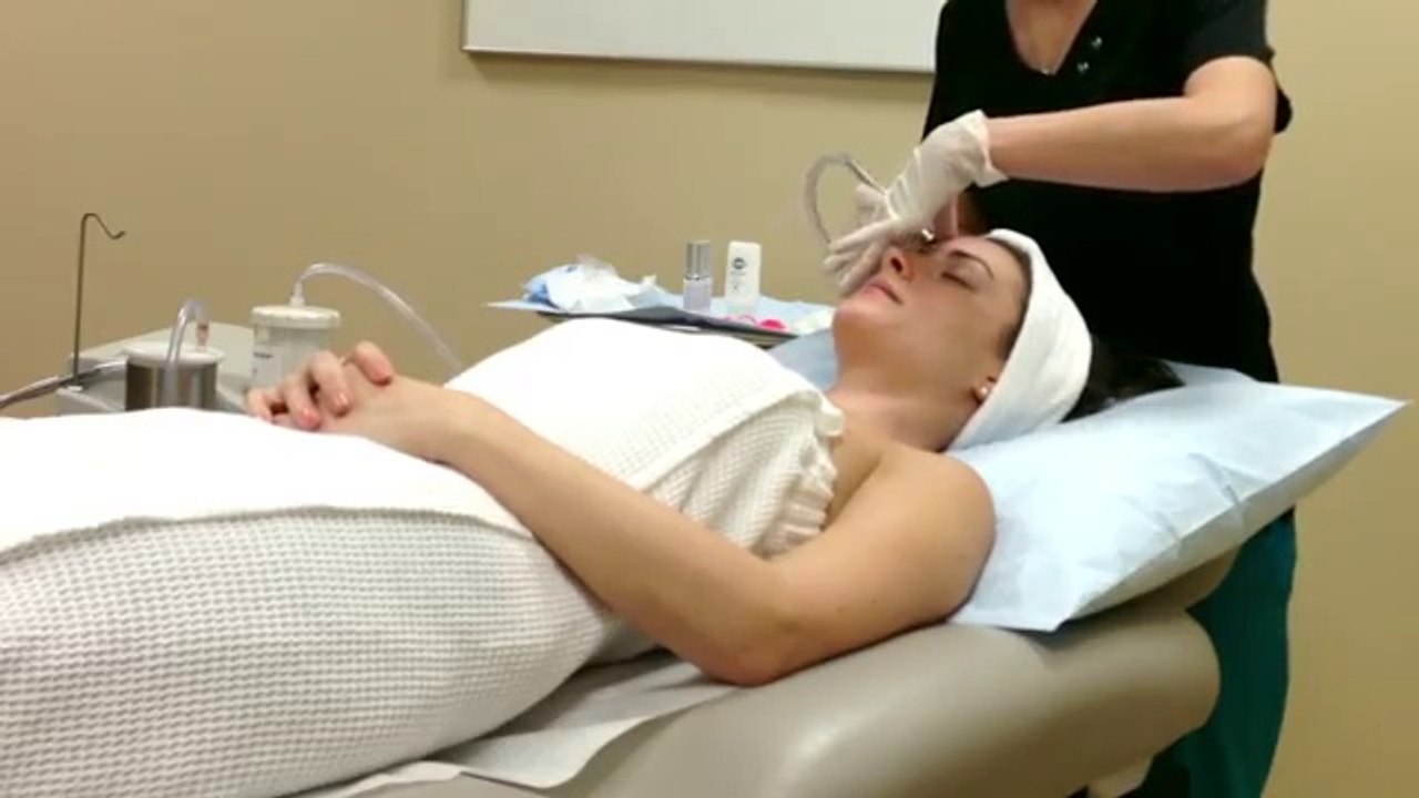 DermaSweep Microdermabrasion at Jandali Plastic Surgery in Connecticut