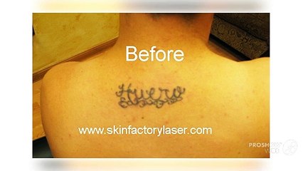 Before and After – Laser Tattoo Removal