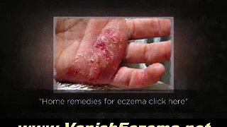 Beat Eczema With These Home Remedies