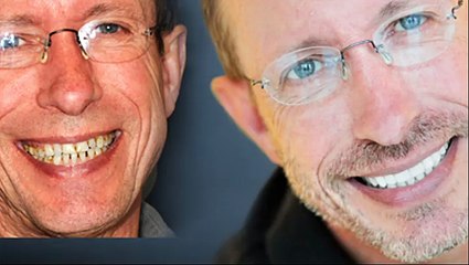 Full Mouth Reconstruction - Long Island, Levittown, Garden City