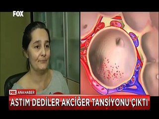 Astım dediler Akciğer tansiyonu çıktı geç kalınsa yaşamayacaktı