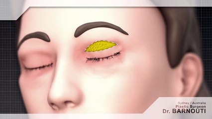 Eyelid surgery sydney