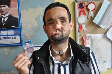 Yüz Nakli Yapılan Sert, Evleniyor