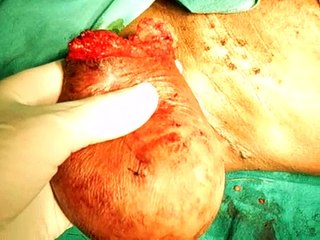 Lipoma removed in ZA (Soweto)