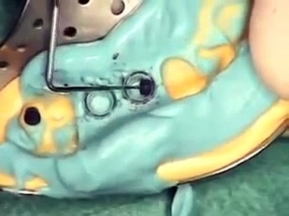 Implant dentistry milpitas, Implant dentist milpitas