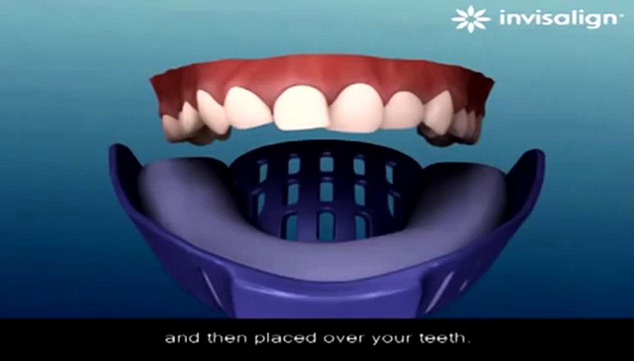 Invisalign milpitas, invisalign milpitas CA