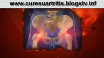 Cure Su Artritis Para Siempre si, Cure su artritis