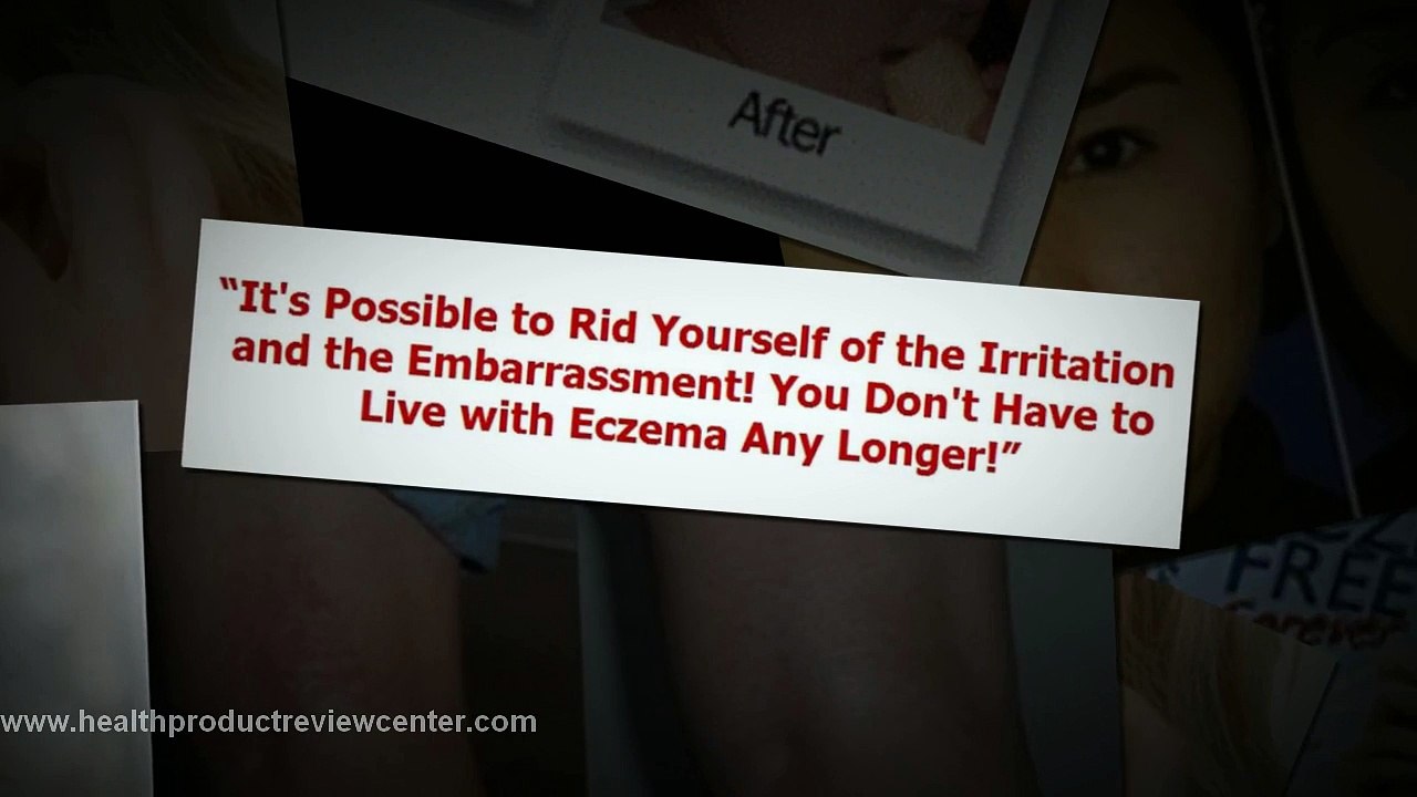 Eczema Free Forever Review