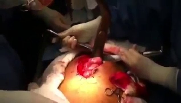 Avoir un poisson vivant dans les intestins!