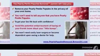 Download Video: Pearly Penile Papules Removal Cost Pearly Penile Papules Removal Home Remedy