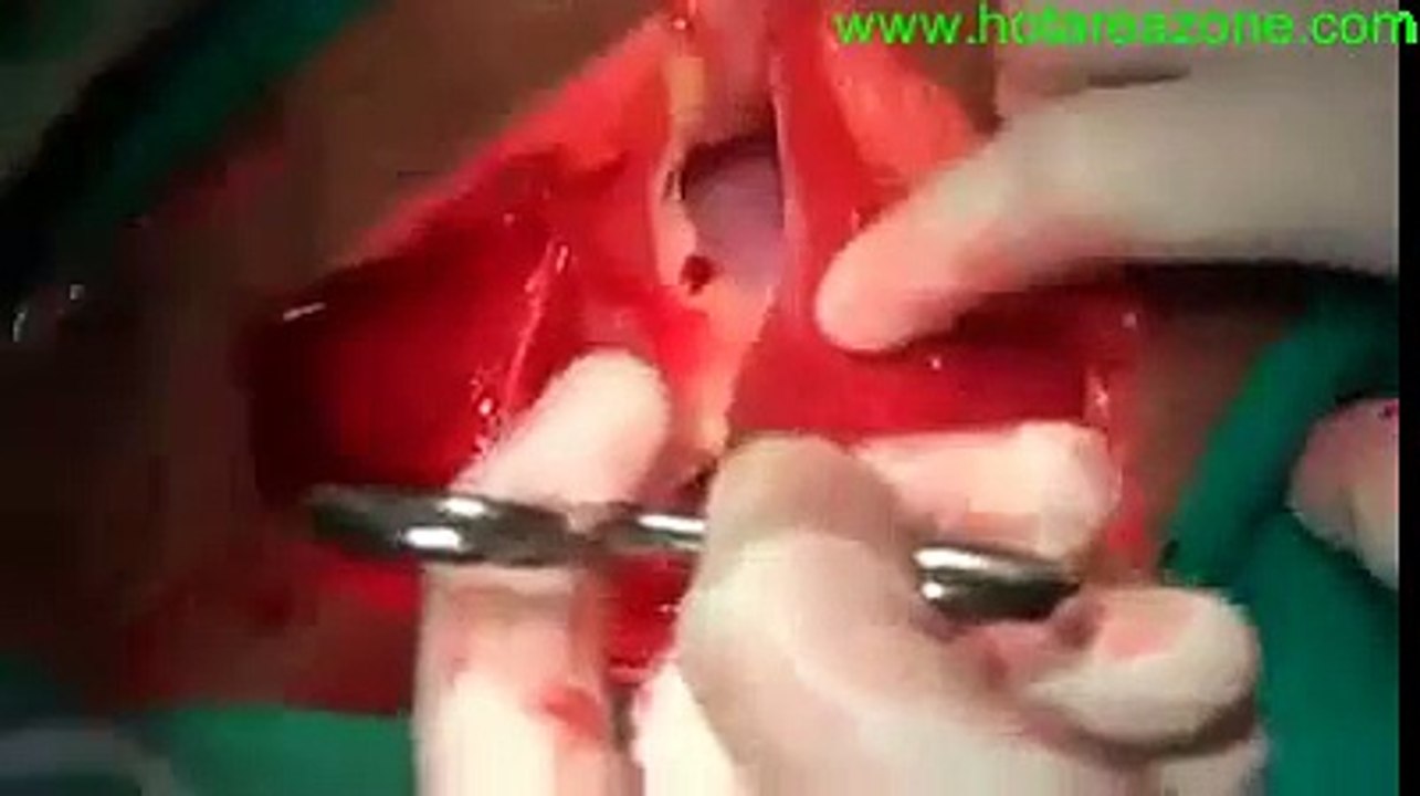 delivering a baby by operation
