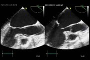 ACUTE PULMONARY OEDEMA due to ECLIPSED FUNCTIONNAL MITRAL REGURGITATION ECHOCARDIOGRAPHY